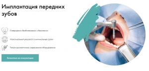 зубные импланты